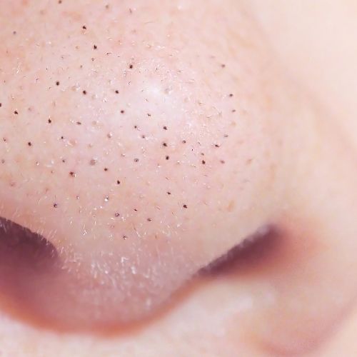 Closeup of blackheads on the nose