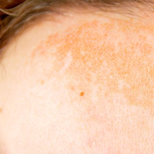Closeup on hyperpigmentation or dark spots on forehead