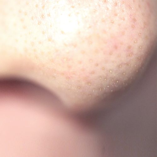 Closeup of sebaceous filaments on the nose