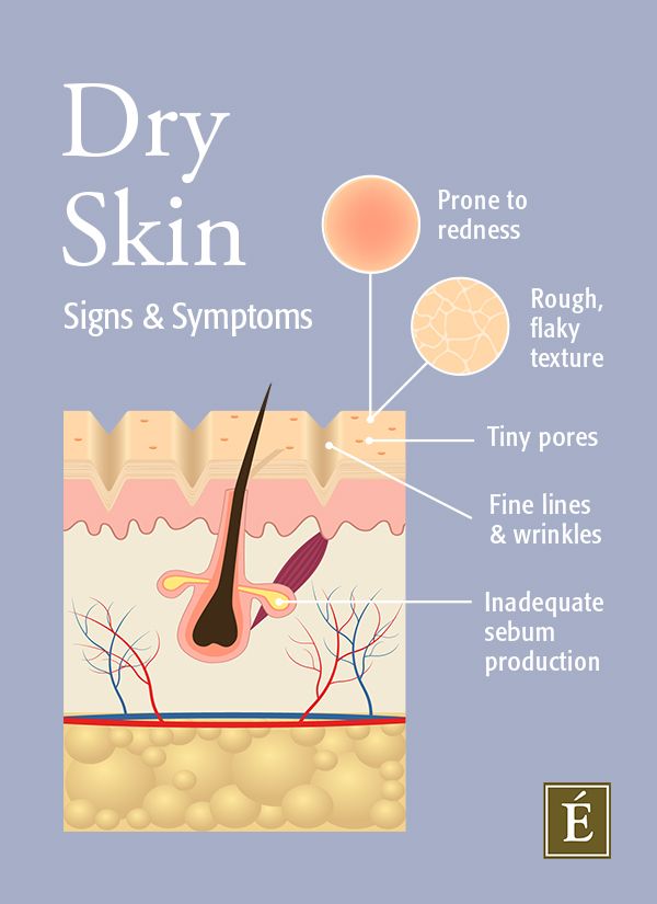 Dry skin signs and symptoms