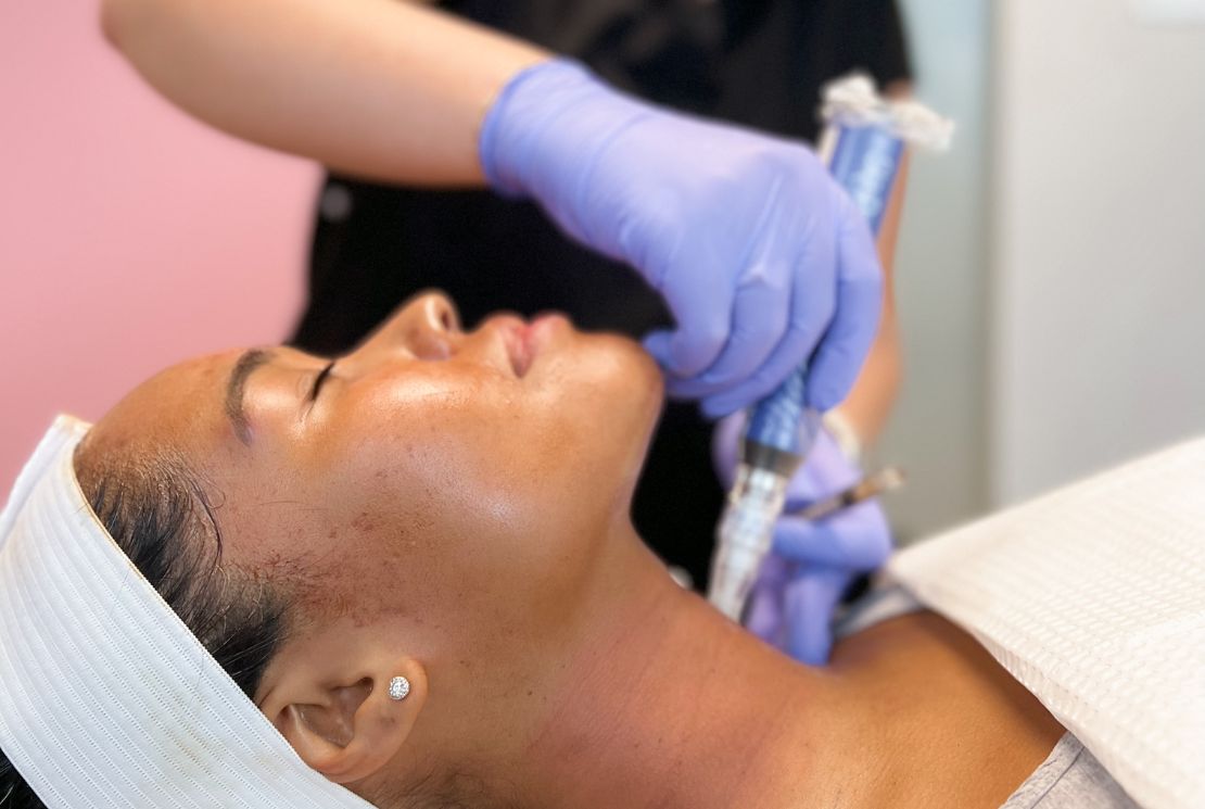 4 Ways Microneedling Helps With Skin Texture