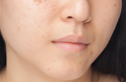 Acne scarring