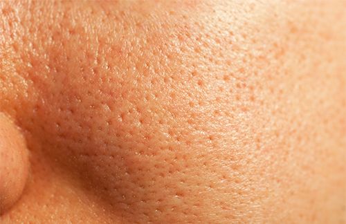 Skin with large pores